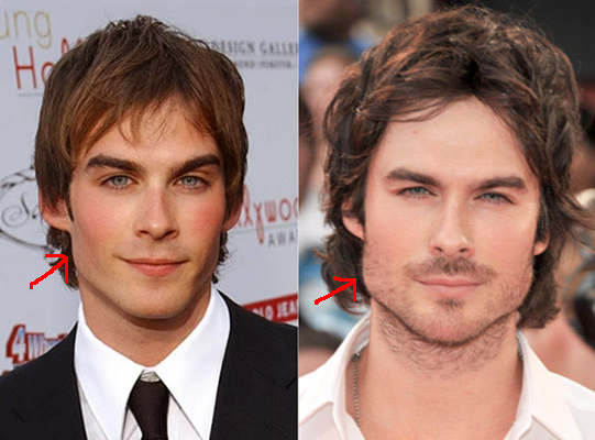 Ian Somerhalder après chirurgie de la mâchoire